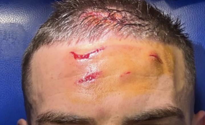 造点建功，克尔斯托维奇晒出被本塞拜尼踢伤的伤口照片